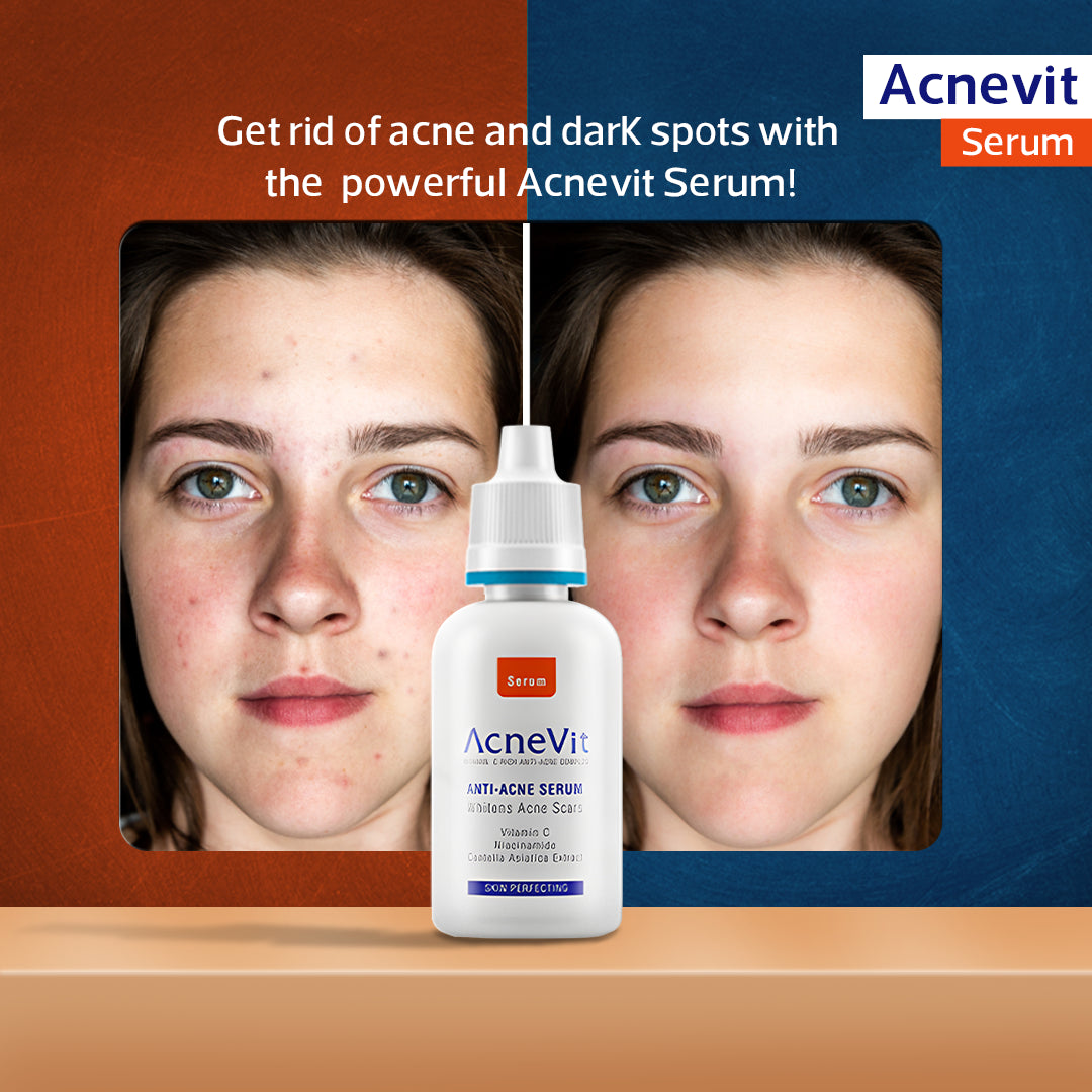 acnevit_serum (2)